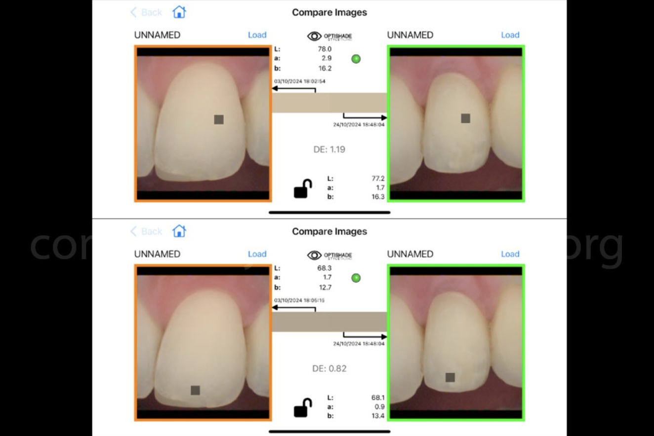 Điều Trị Lại Một Mão Răng Trên Implant: Tối ưu hoá kết quả bằng phần mềm OptiShade